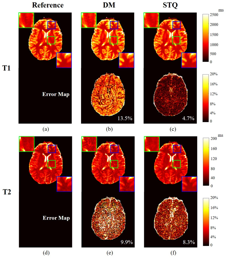Deep learning for undersampled MR fingerprinting
